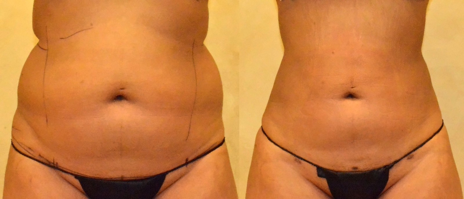 Before/After Lipo 360 before and after, actual patient of Dr. Long
