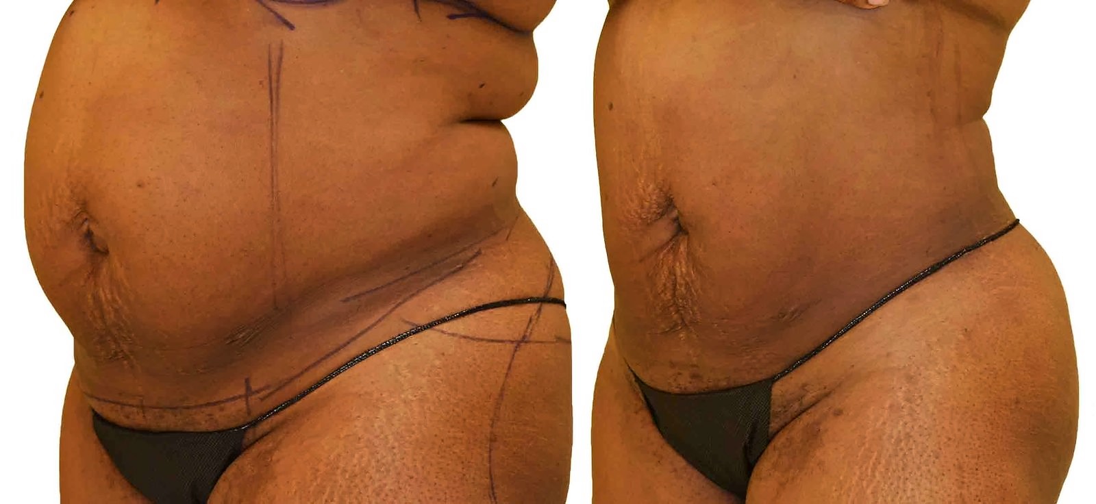 Before/After Lipo 360 before and after, actual patient of Dr. Long