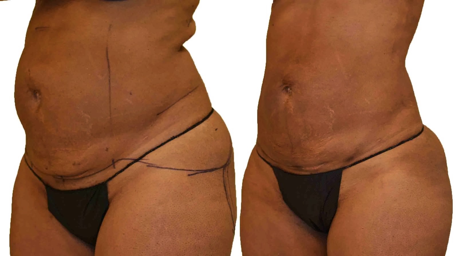 Before/After Lipo 360 before and after, actual patient of Dr. Long