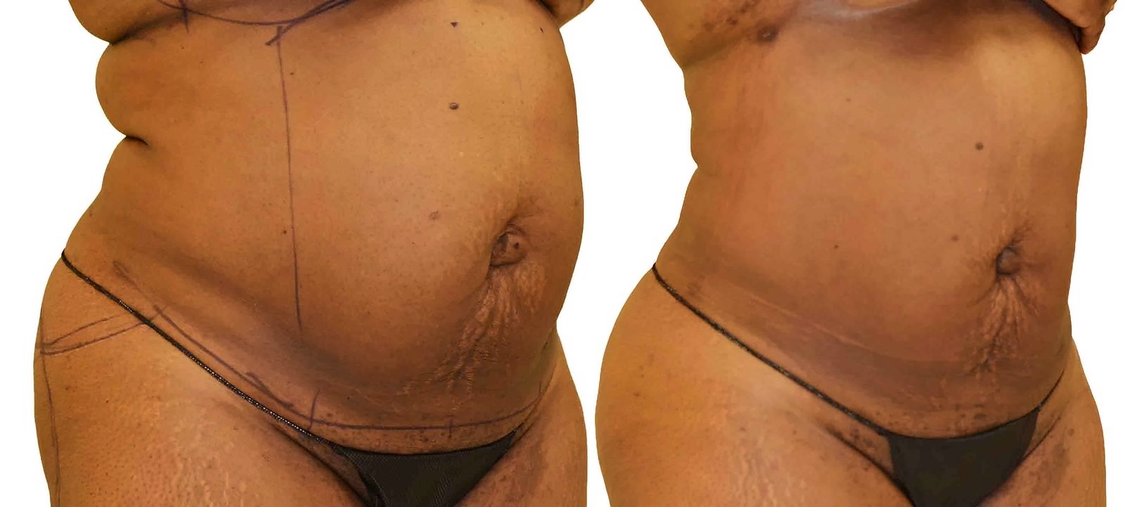 Before/After Lipo 360 before and after, actual patient of Dr. Long