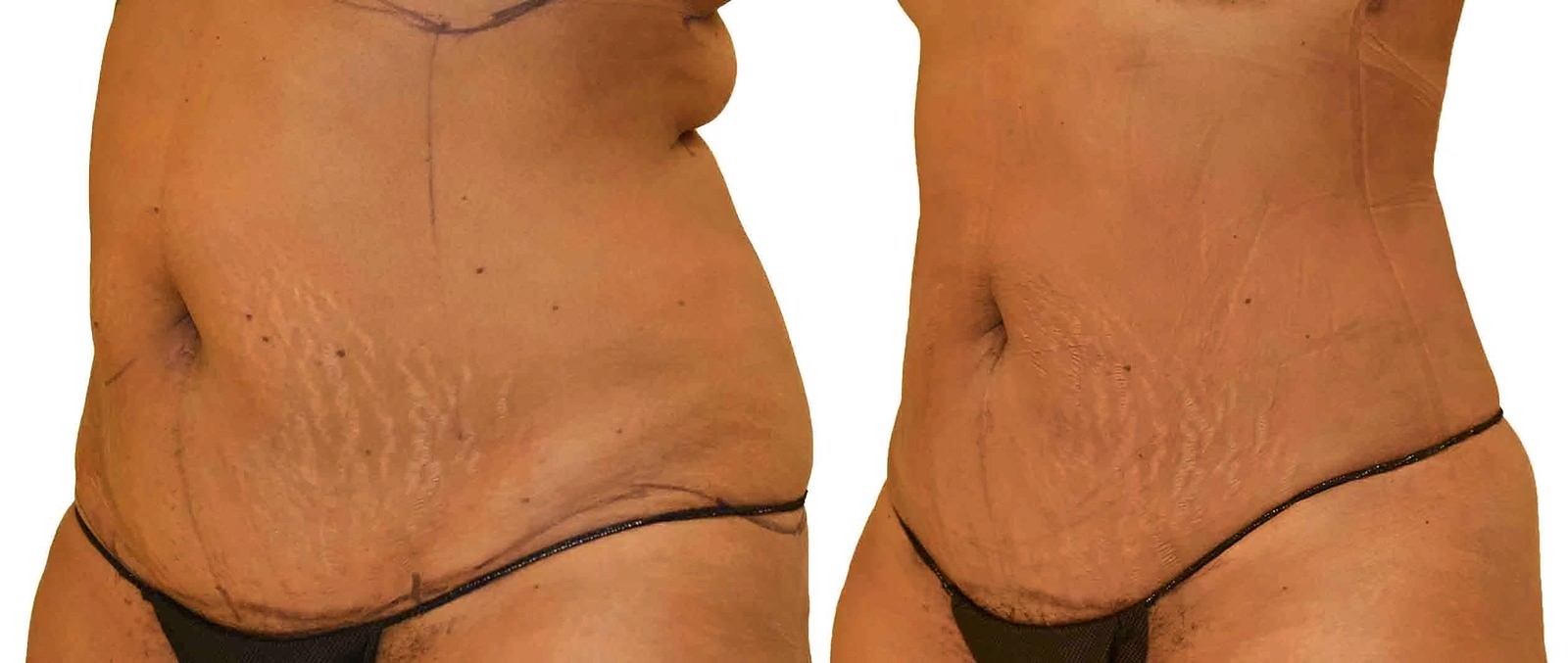Before/After Lipo 360 before and after, actual patient of Dr. Long