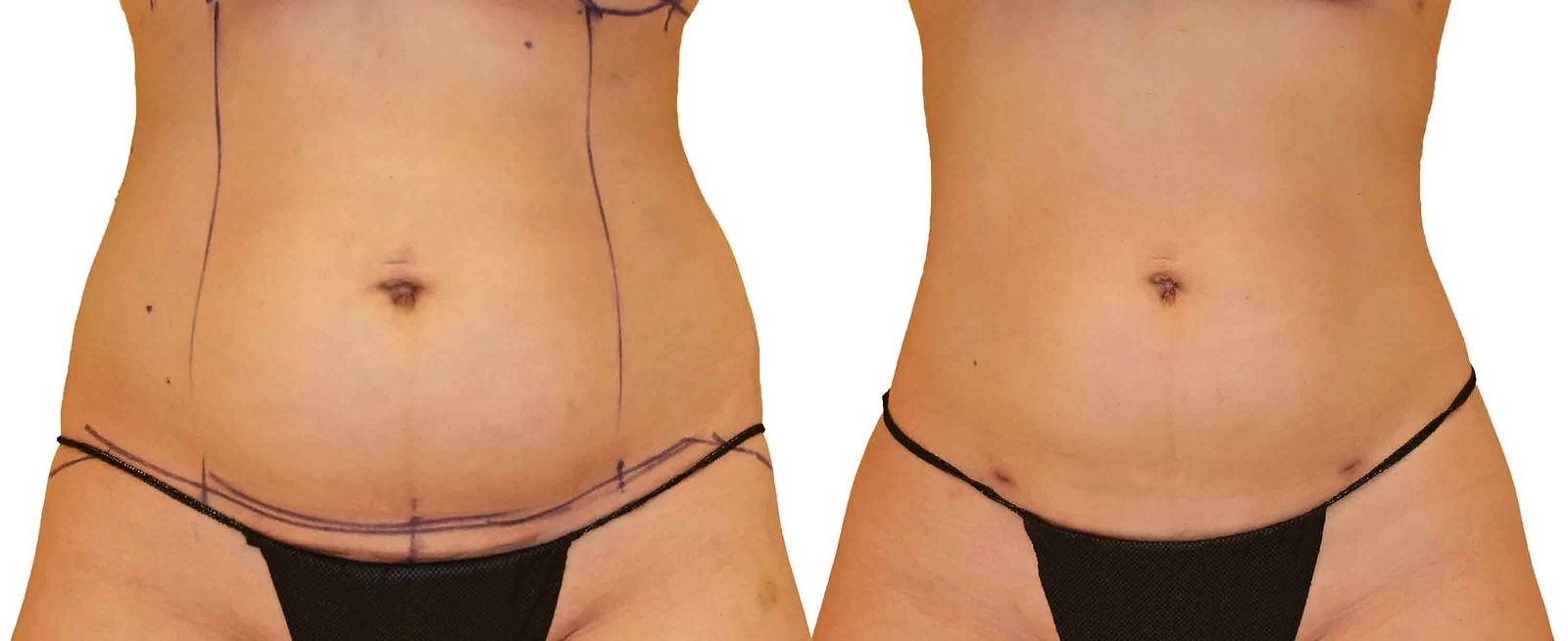 Before/After Lipo 360 before and after, actual patient of Dr. Long