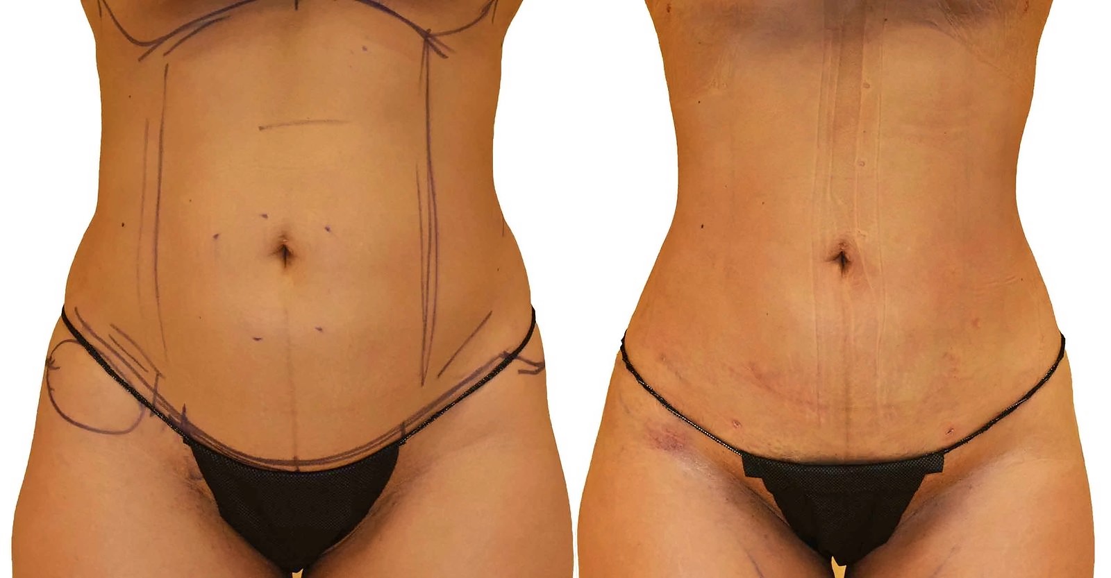 Before/After Lipo 360 before and after, actual patient of Dr. Long