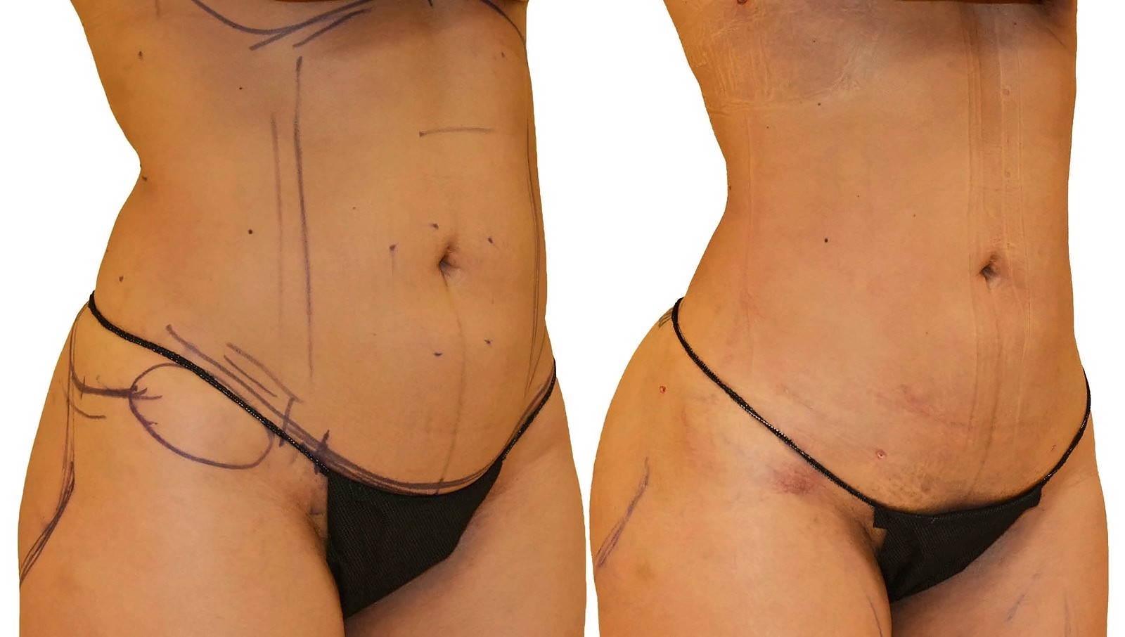 Before/After Lipo 360 before and after, actual patient of Dr. Long