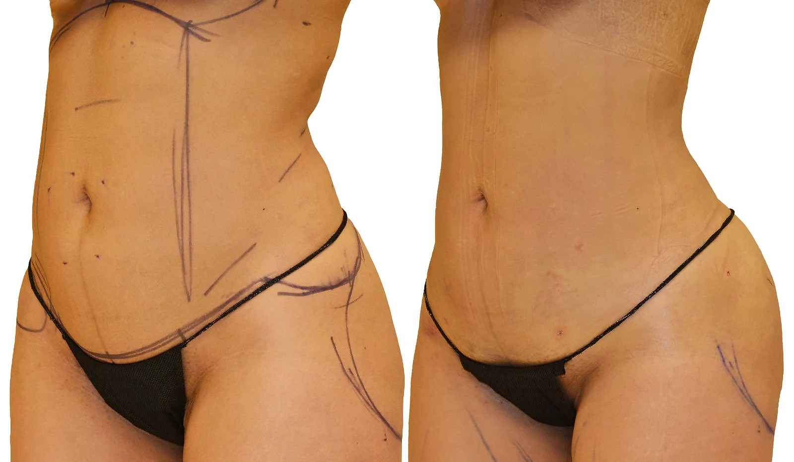 Before/After Lipo 360 before and after, actual patient of Dr. Long