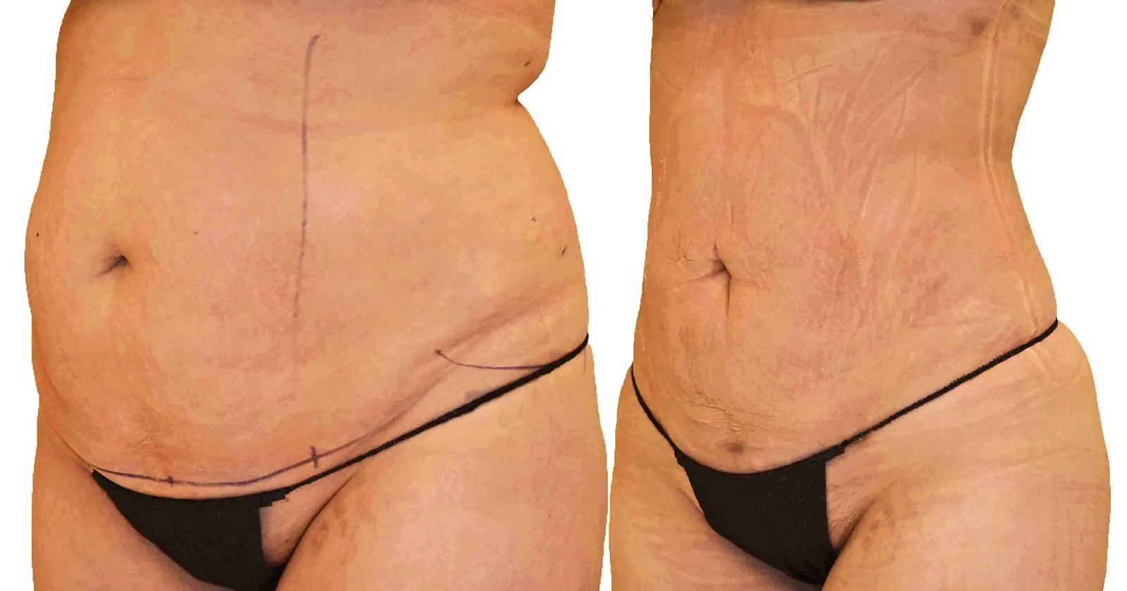 Before/After Lipo 360 before and after, actual patient of Dr. Long