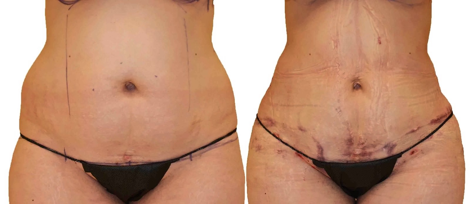 Before/After Lipo 360 before and after, actual patient of Dr. Long