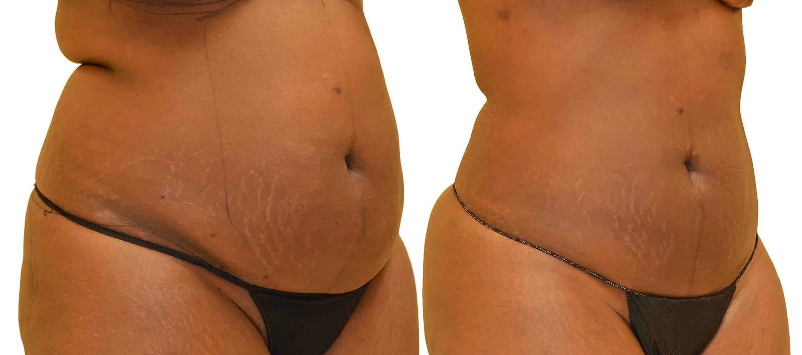 Before/After Lipo 360 before and after, actual patient of Dr. Long