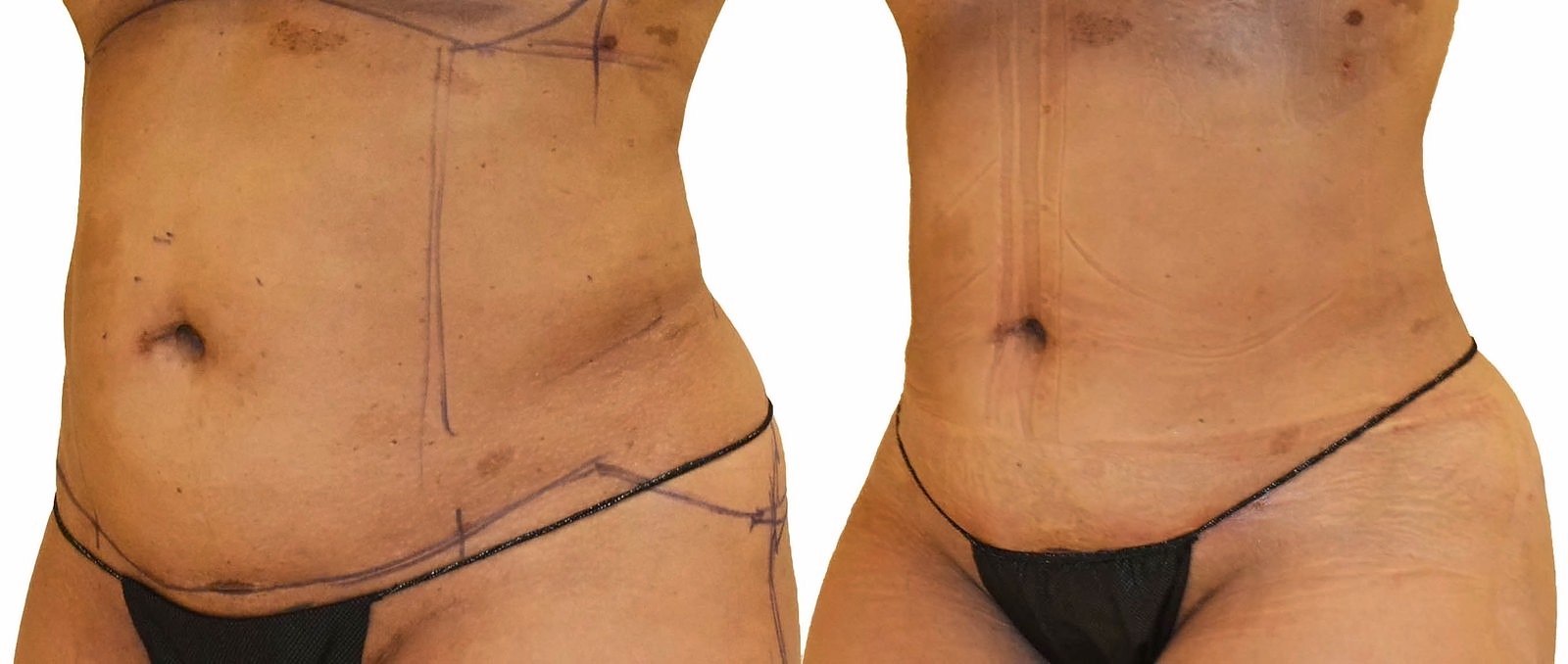 Before/After Lipo 360 before and after, actual patient of Dr. Long
