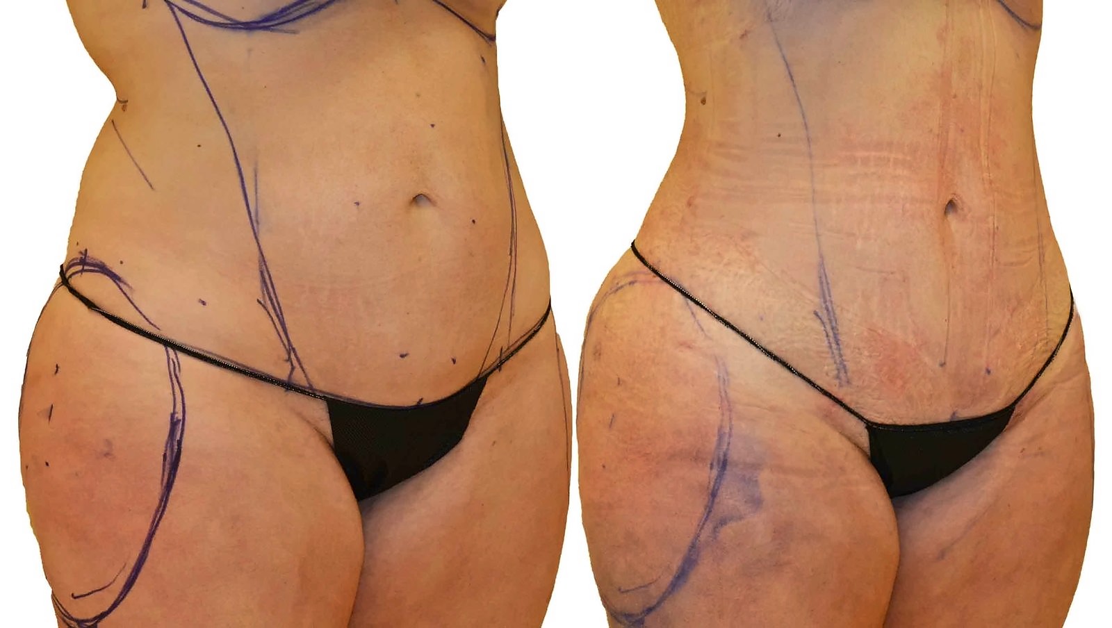 Before/After Lipo 360 before and after, actual patient of Dr. Long