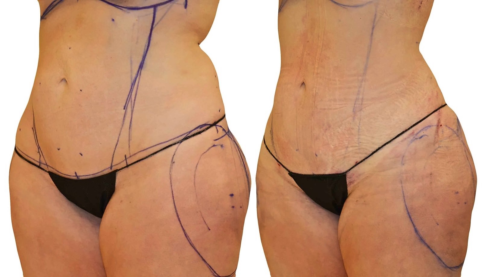 Before/After Lipo 360 before and after, actual patient of Dr. Long