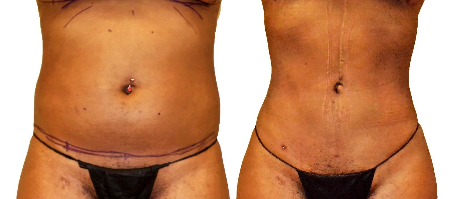Before/After Lipo 360 before and after, actual patient of Dr. Long