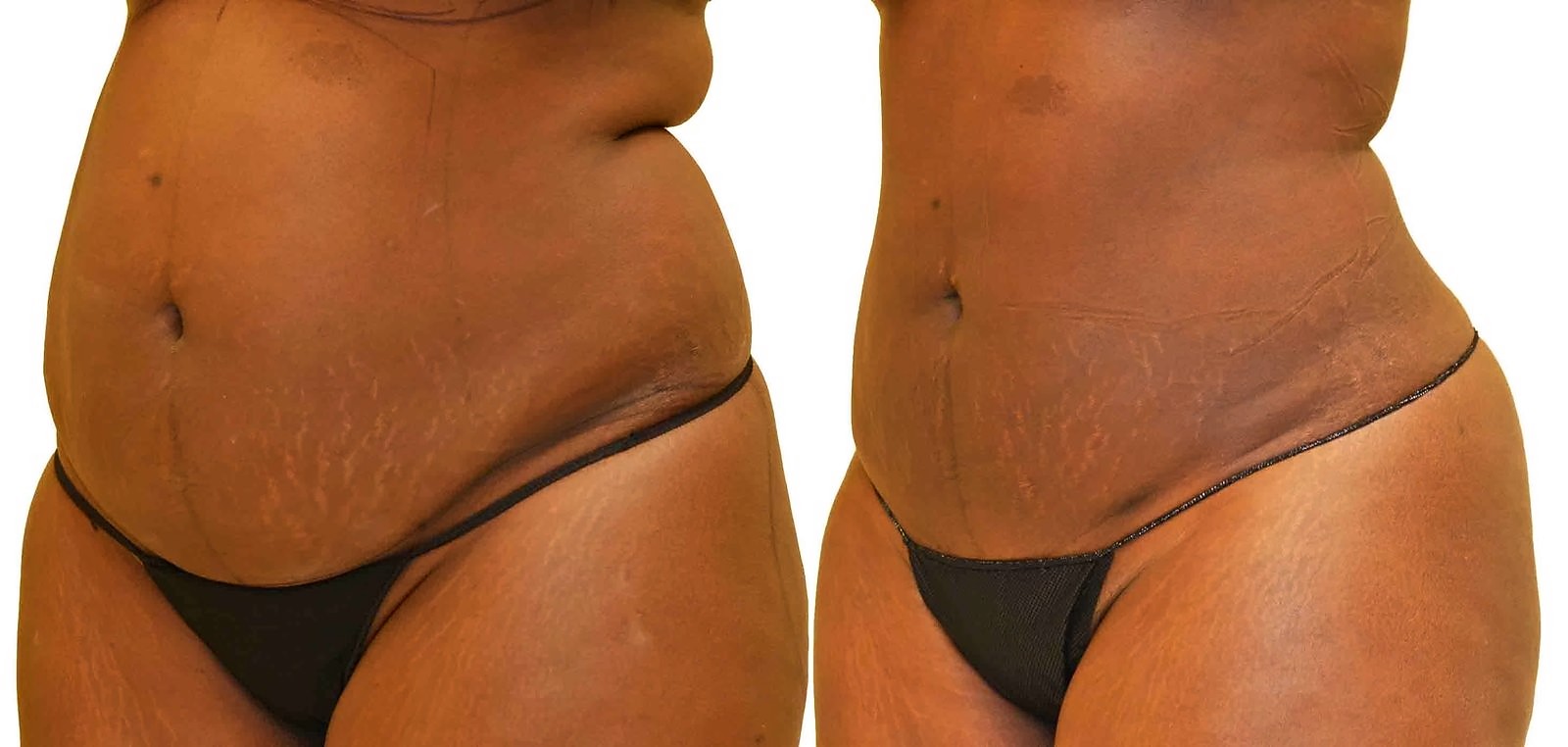 Before/After Lipo 360 before and after, actual patient of Dr. Long