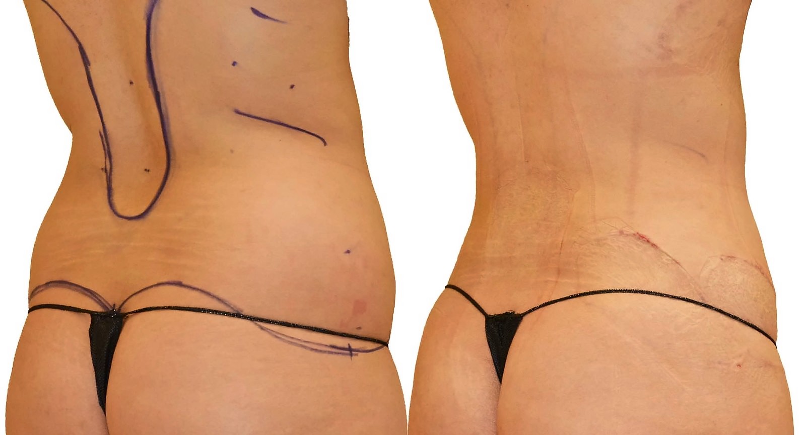 Before/After Lipo 360 before and after, actual patient of Dr. Long