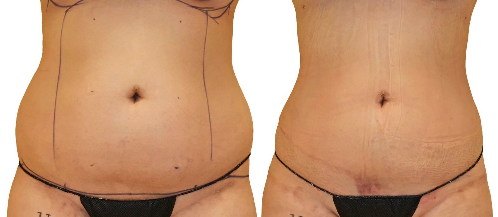 Before/After Lipo 360 before and after, actual patient of Dr. Long