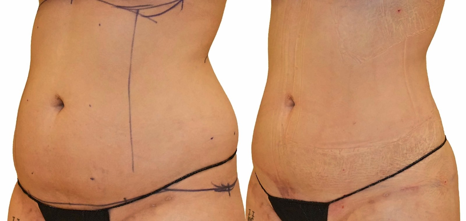 Before/After Lipo 360 before and after, actual patient of Dr. Long