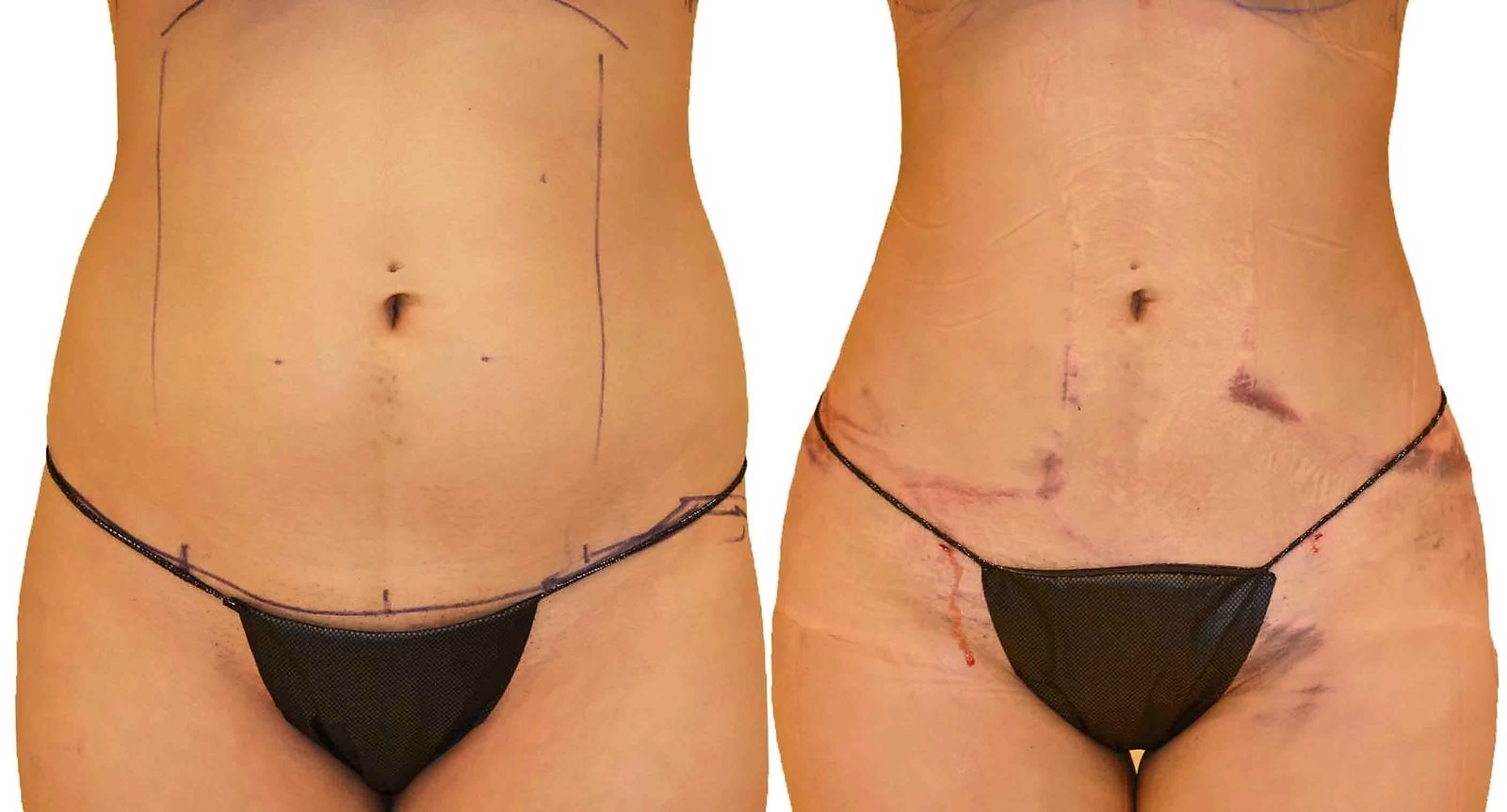 Before/After Lipo 360 before and after, actual patient of Dr. Long