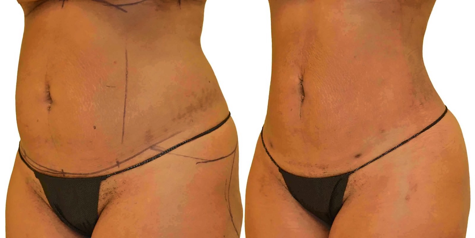 Before/After Lipo 360 before and after, actual patient of Dr. Long
