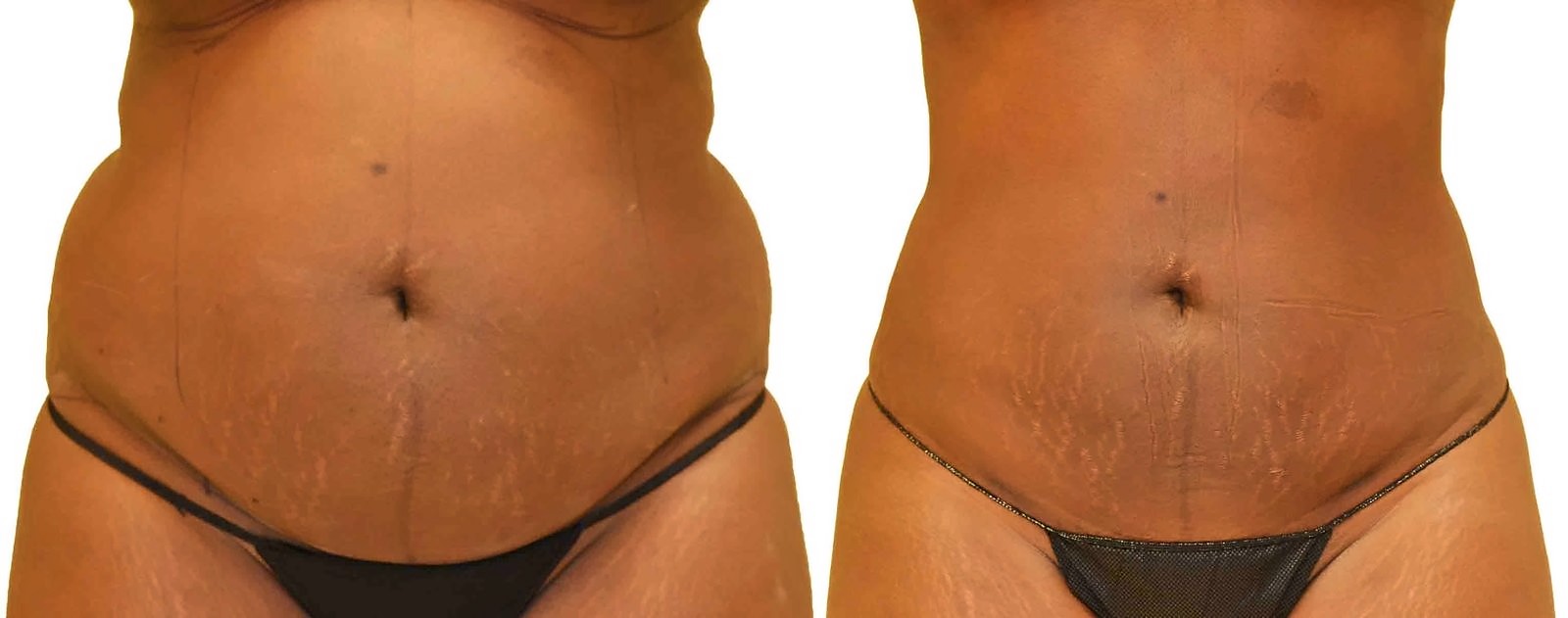 Before/After Lipo 360 before and after, actual patient of Dr. Long