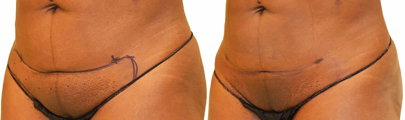 Before/After Lipo 360 before and after, actual patient of Dr. Long