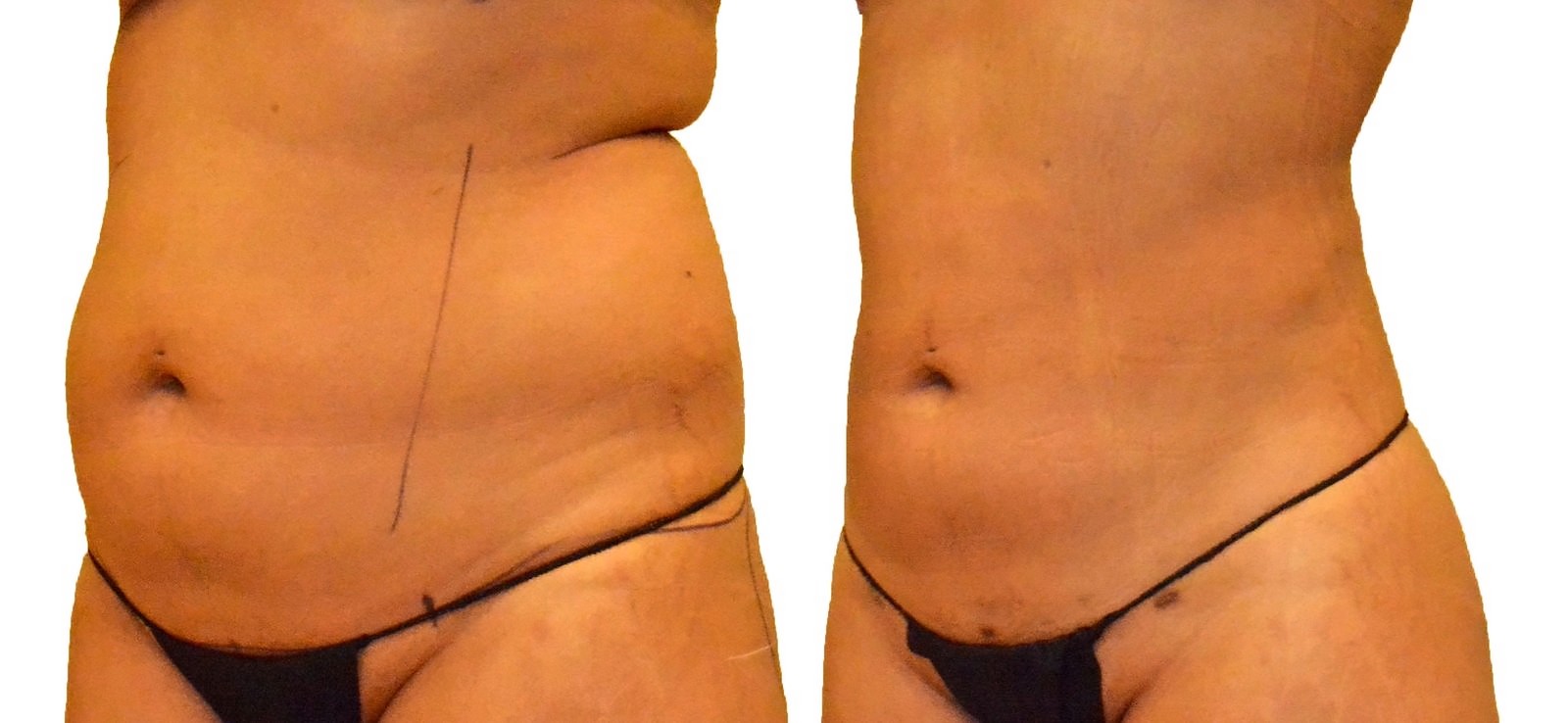 Before/After Lipo 360 before and after, actual patient of Dr. Long