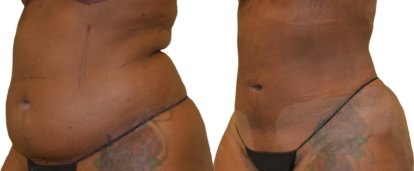 Before/After Lipo 360 before and after, actual patient of Dr. Long