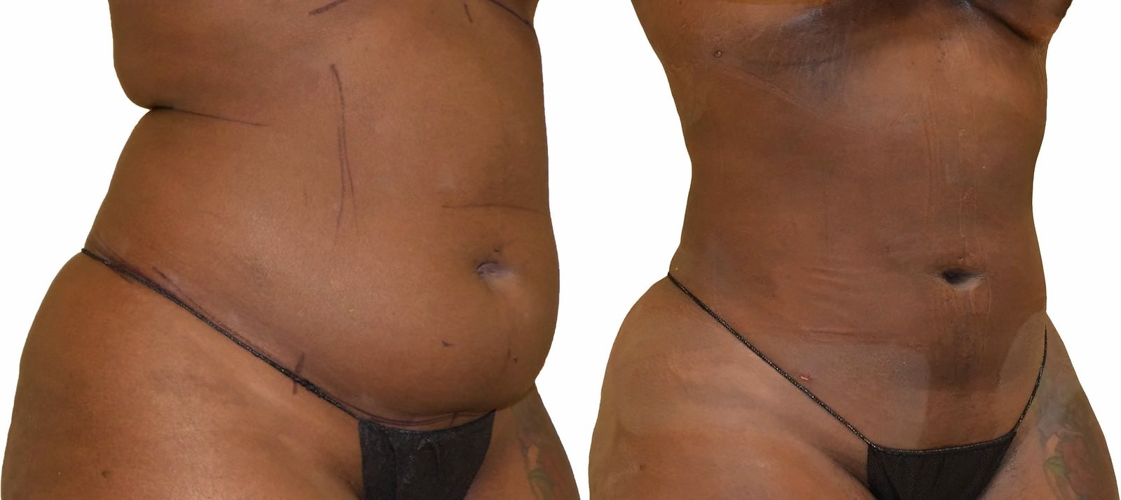 Before/After Lipo 360 before and after, actual patient of Dr. Long