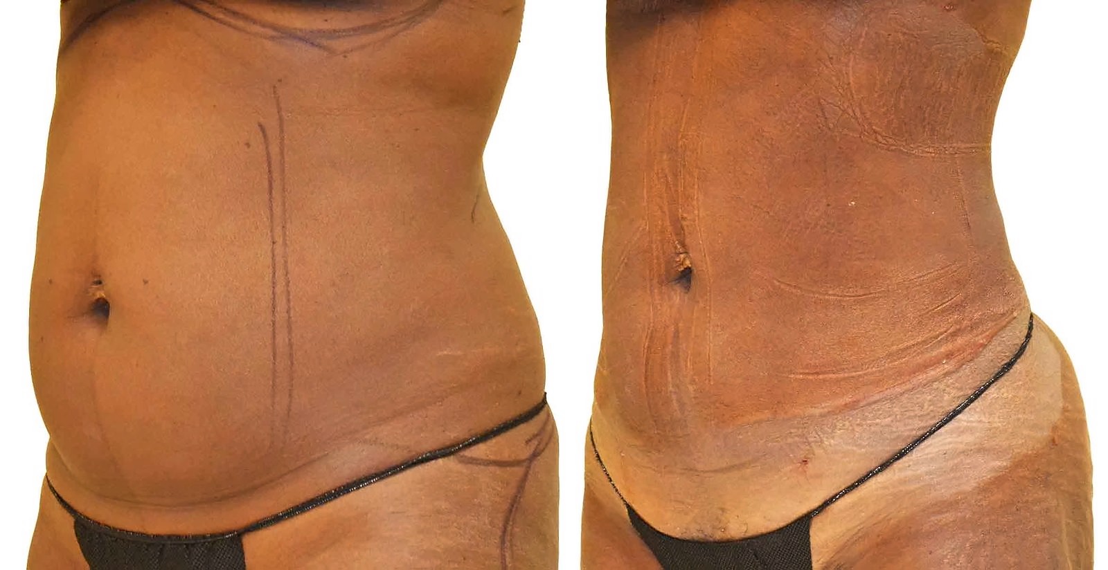 Before/After Lipo 360 before and after, actual patient of Dr. Long