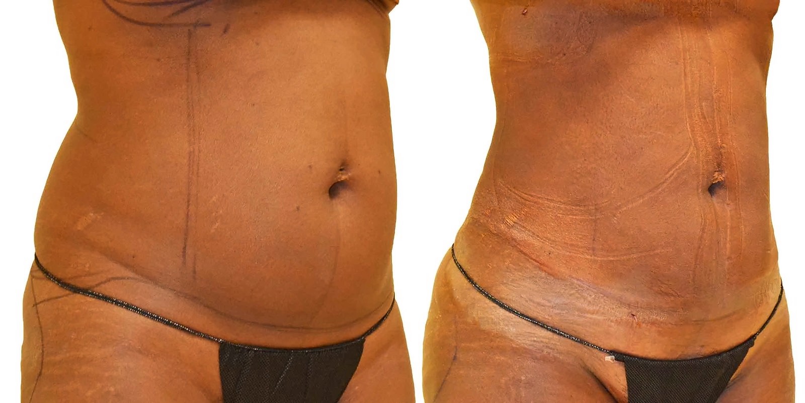 Before/After Lipo 360 before and after, actual patient of Dr. Long