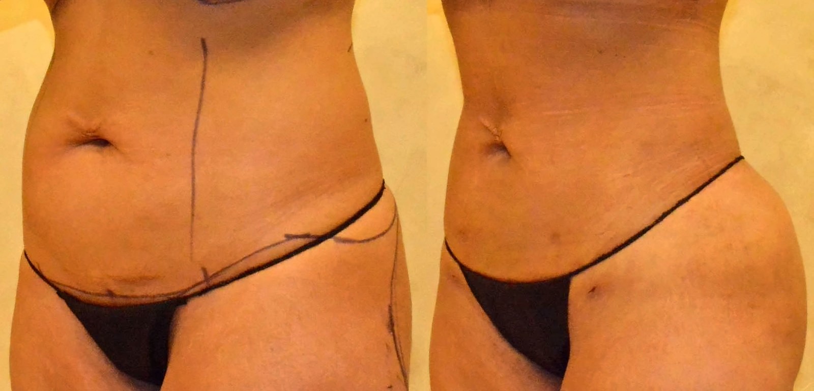 Before/After Lipo 360 before and after, actual patient of Dr. Long