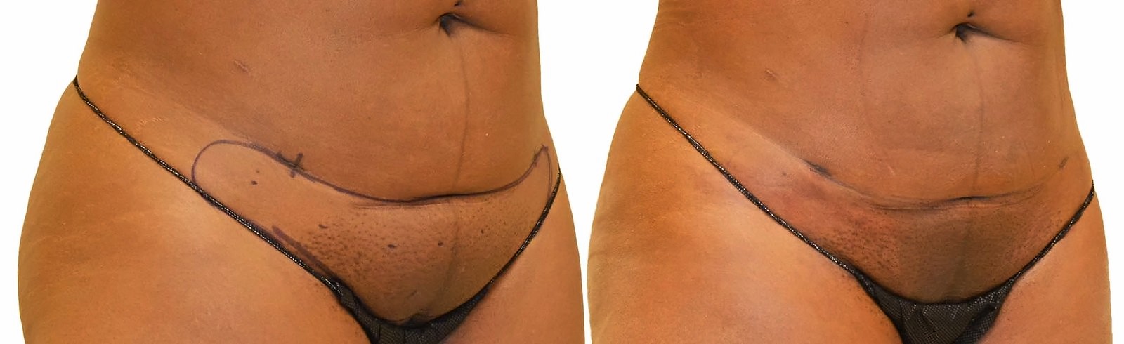 Before/After Lipo 360 before and after, actual patient of Dr. Long