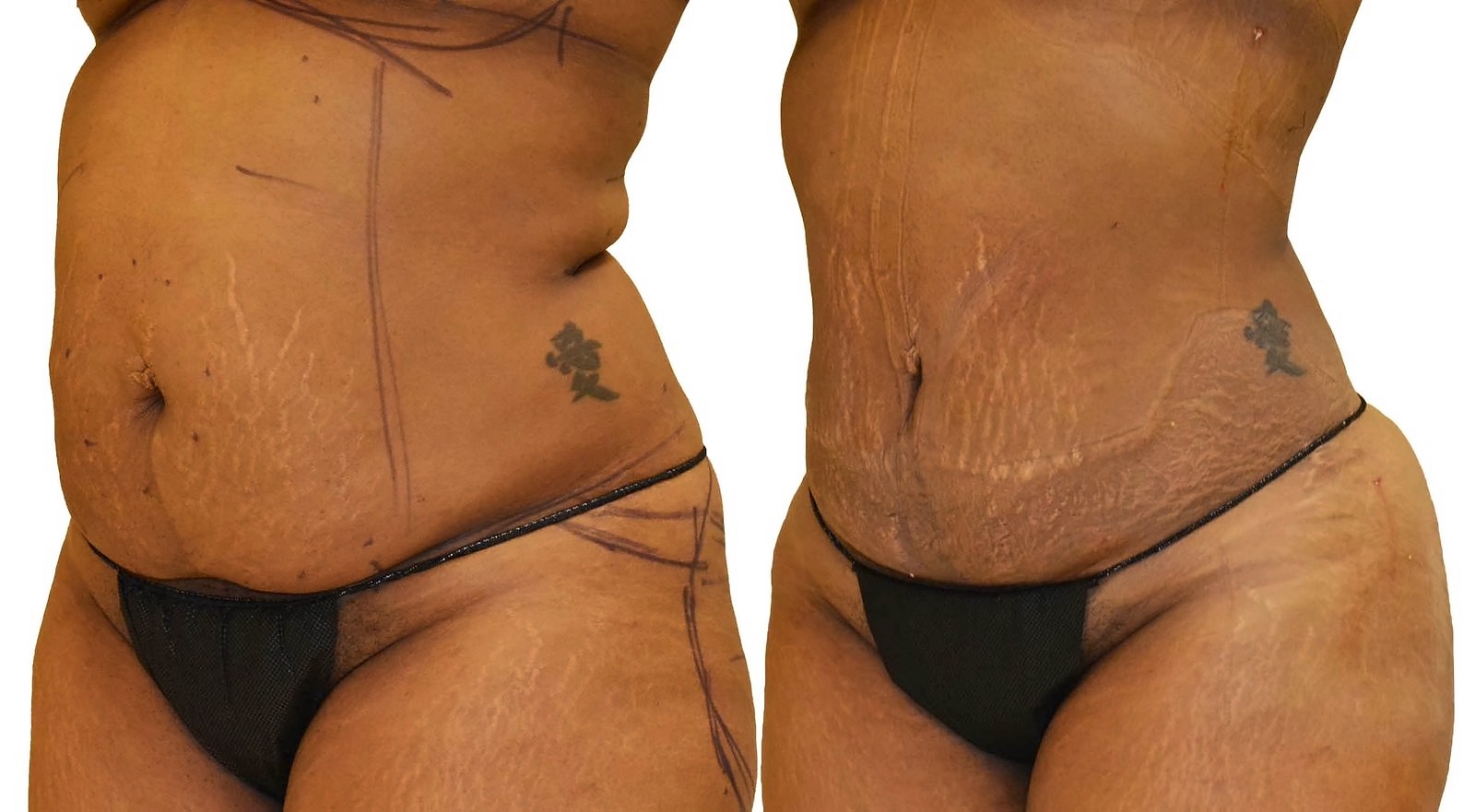 Before/After Lipo 360 before and after, actual patient of Dr. Long