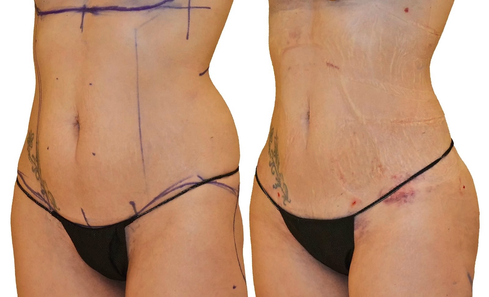 Before/After Lipo 360 before and after, actual patient of Dr. Long