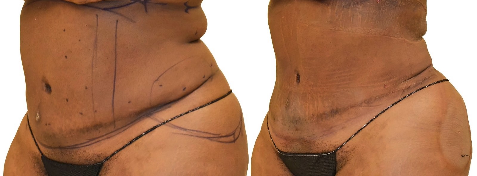 Before/After Lipo 360 before and after, actual patient of Dr. Long