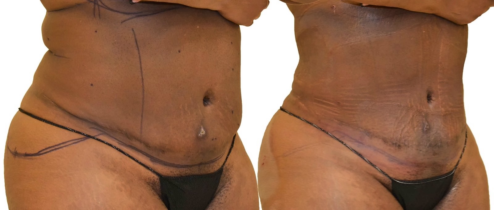 Before/After Lipo 360 before and after, actual patient of Dr. Long