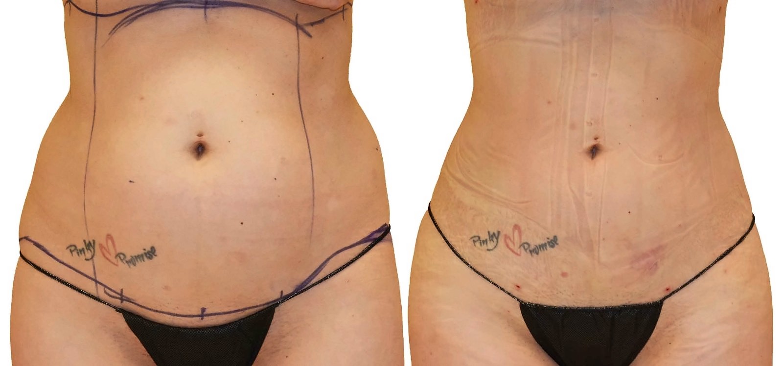 Before/After Lipo 360 before and after, actual patient of Dr. Long