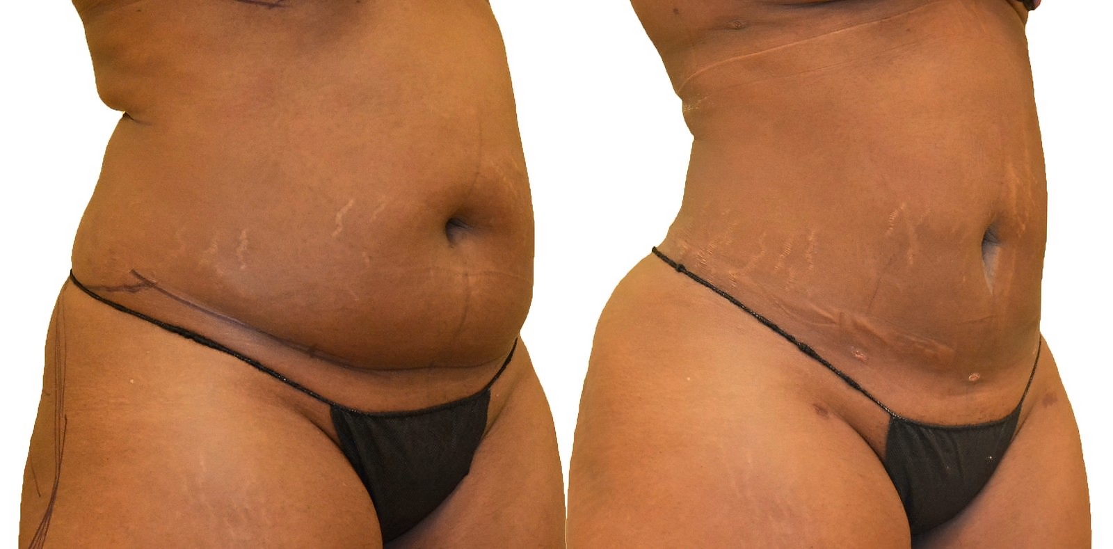 Before/After Lipo 360 before and after, actual patient of Dr. Long