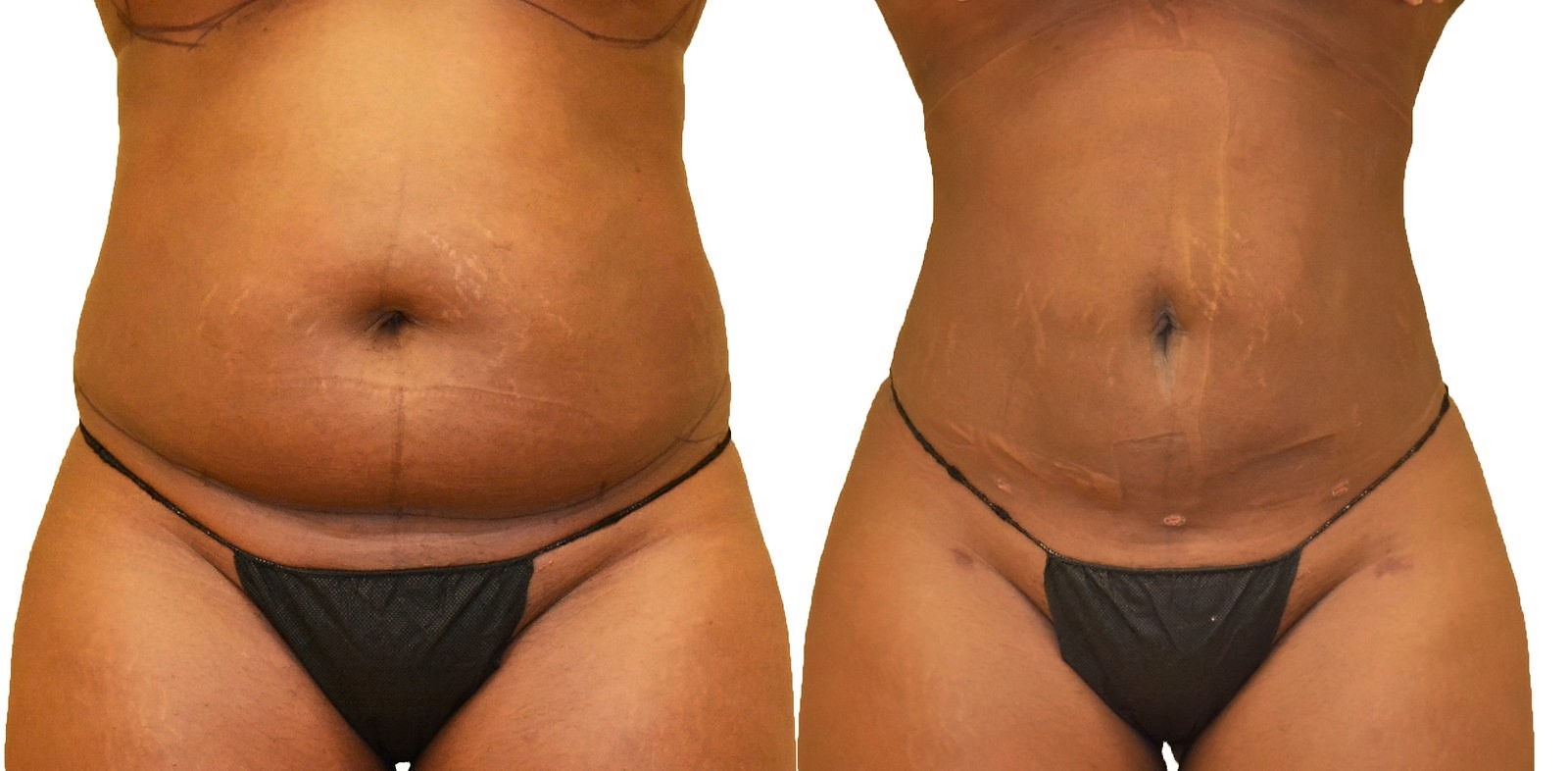 Before/After Lipo 360 before and after, actual patient of Dr. Long