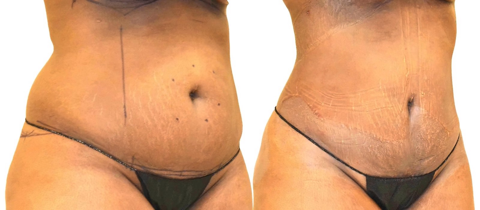 Before/After Lipo 360 before and after, actual patient of Dr. Long