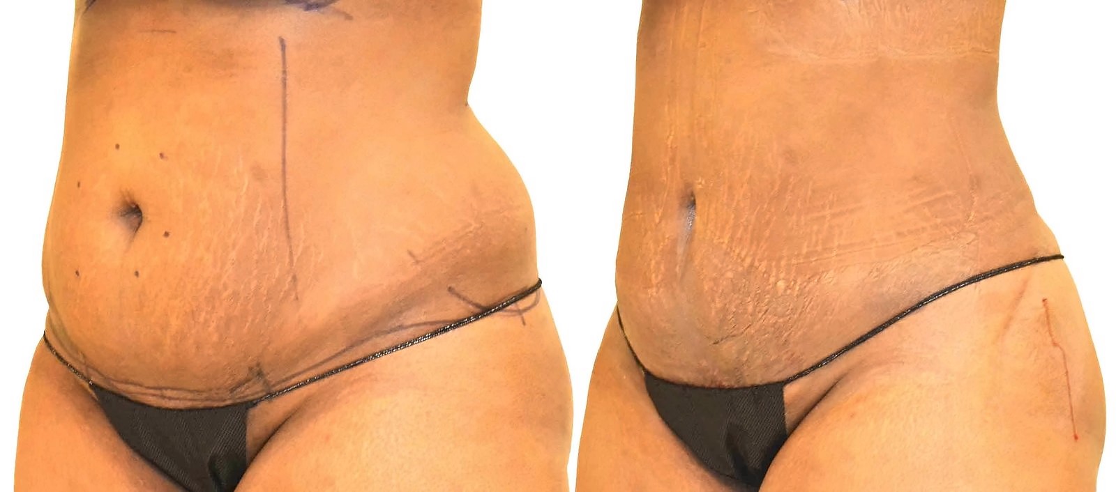 Before/After Lipo 360 before and after, actual patient of Dr. Long