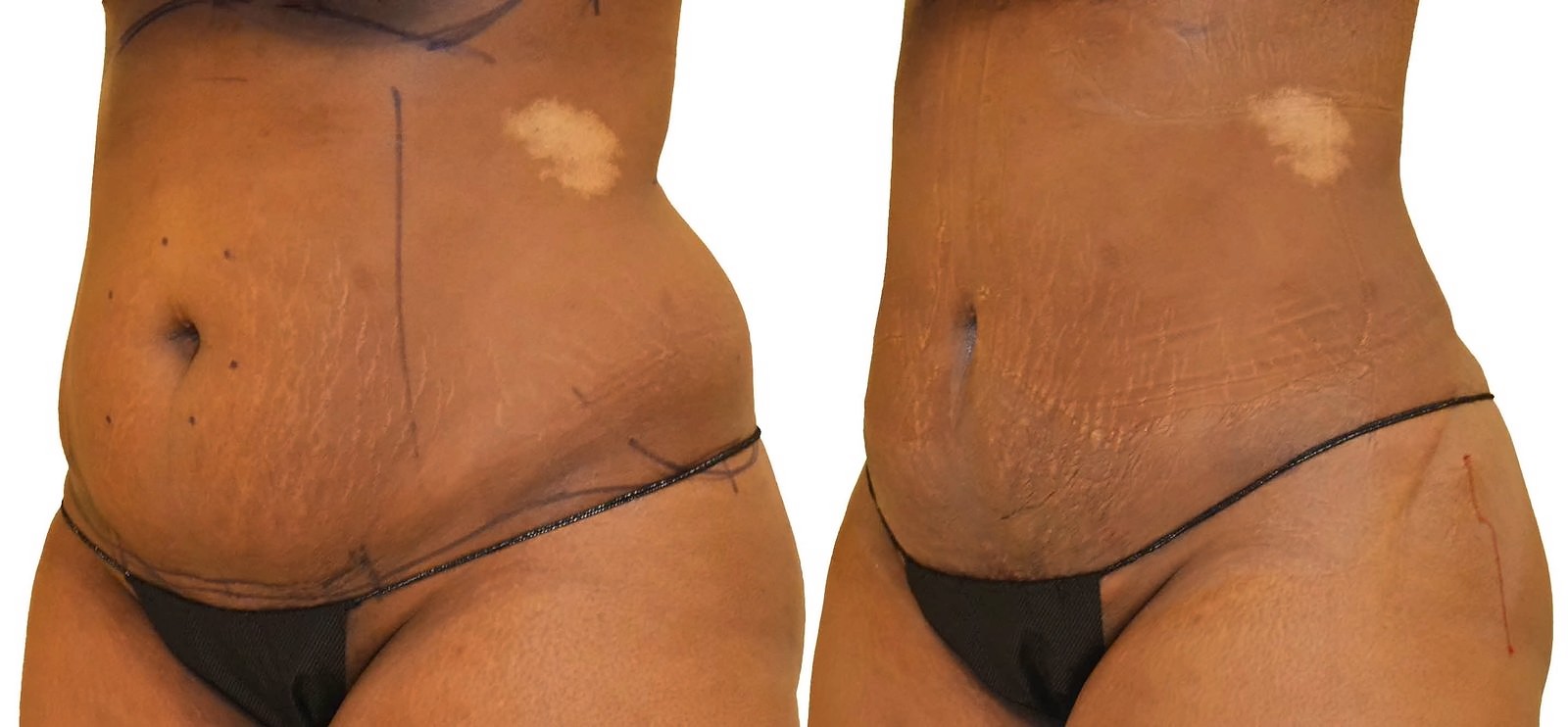 Before/After Lipo 360 before and after, actual patient of Dr. Long