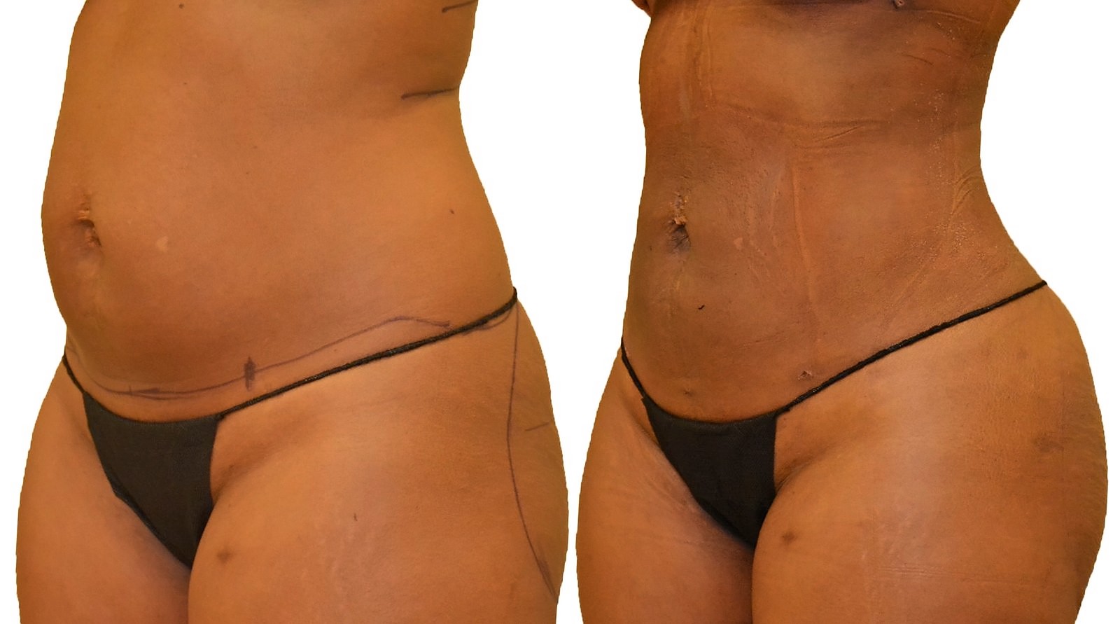 Before/After Lipo 360 before and after, actual patient of Dr. Long