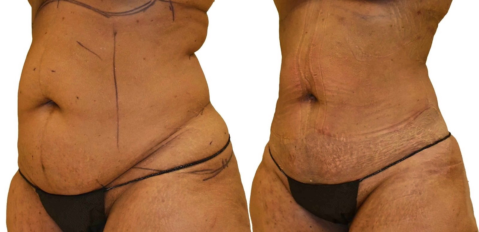 Before/After Lipo 360 before and after, actual patient of Dr. Long