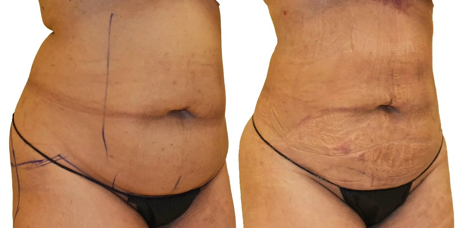 Before/After Lipo 360 before and after, actual patient of Dr. Long