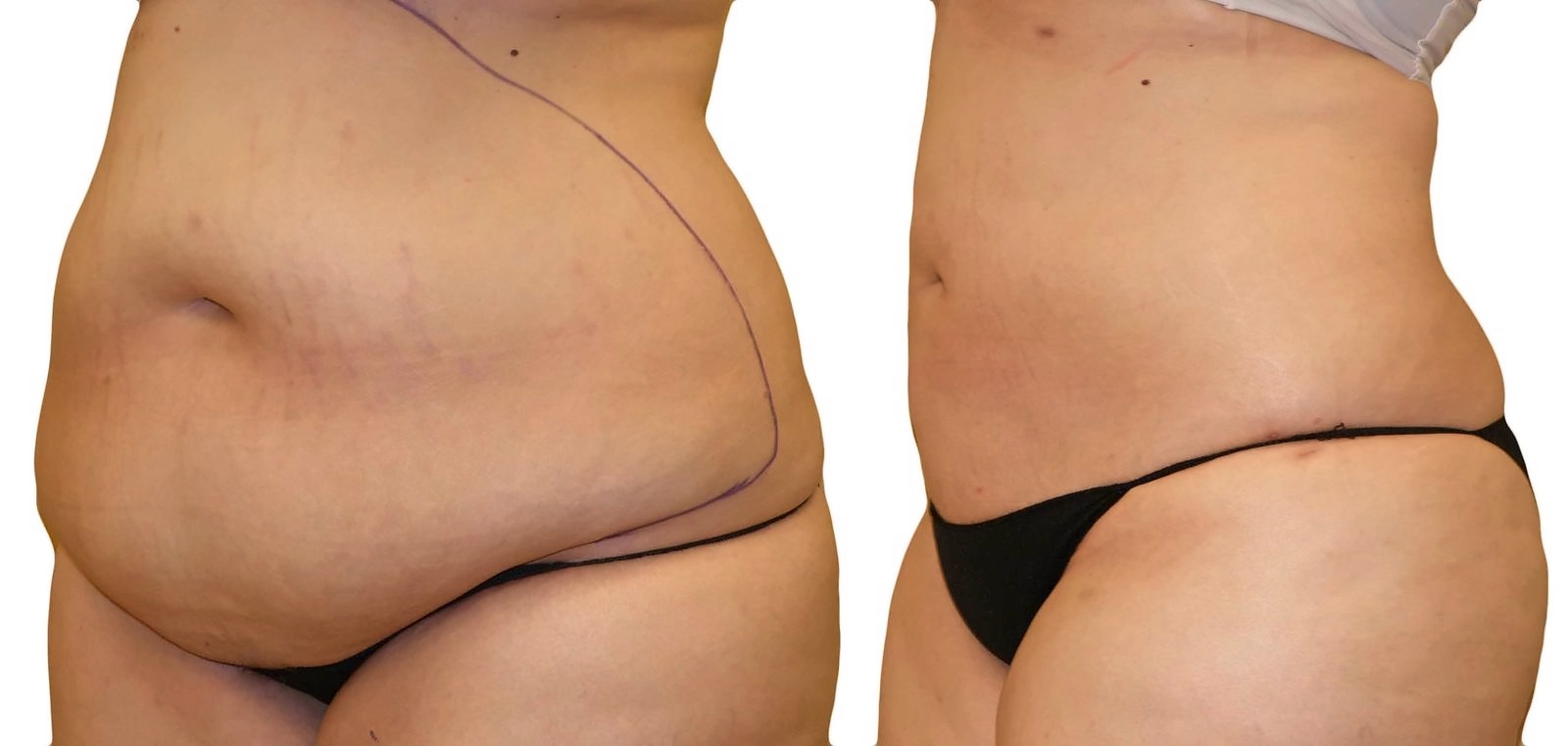 Before/After Lipo 360 before and after, actual patient of Dr. Long