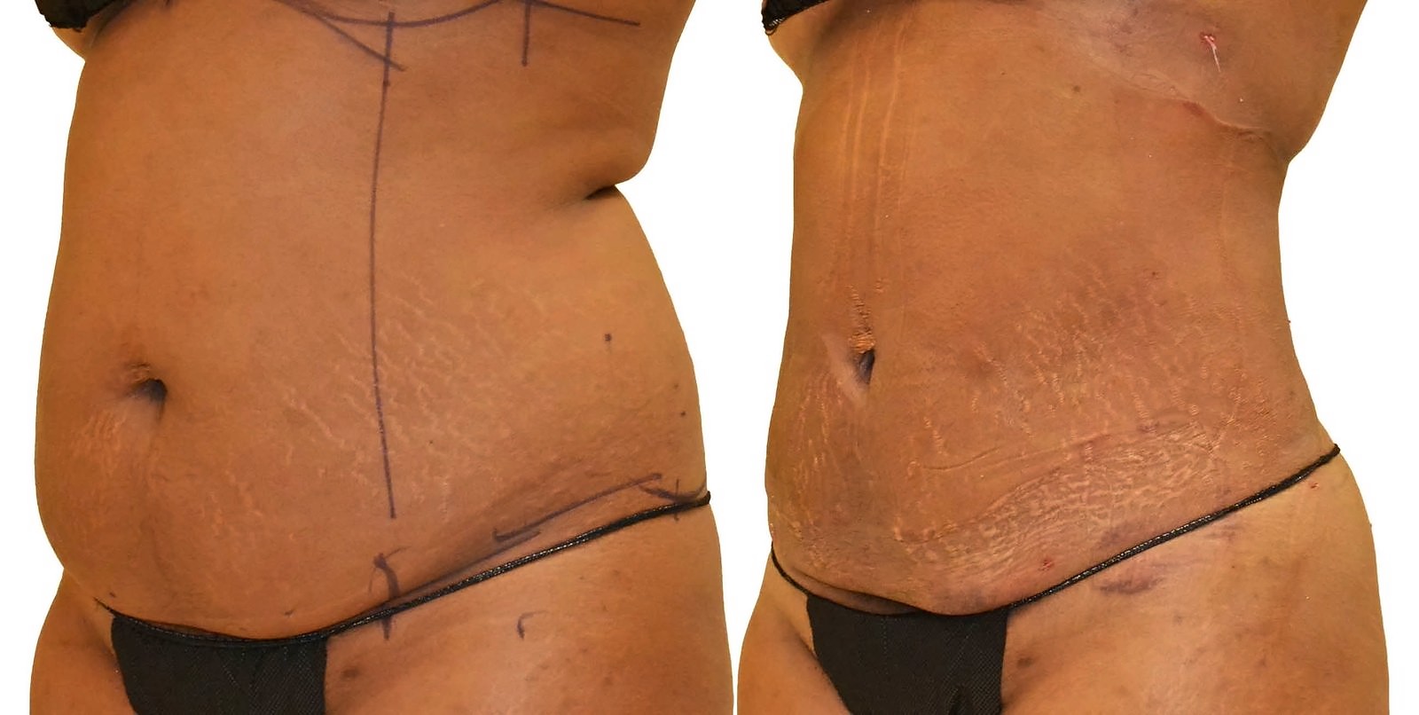 Before/After Lipo 360 before and after, actual patient of Dr. Long