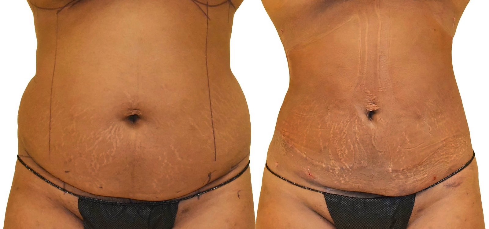 Before/After Lipo 360 before and after, actual patient of Dr. Long