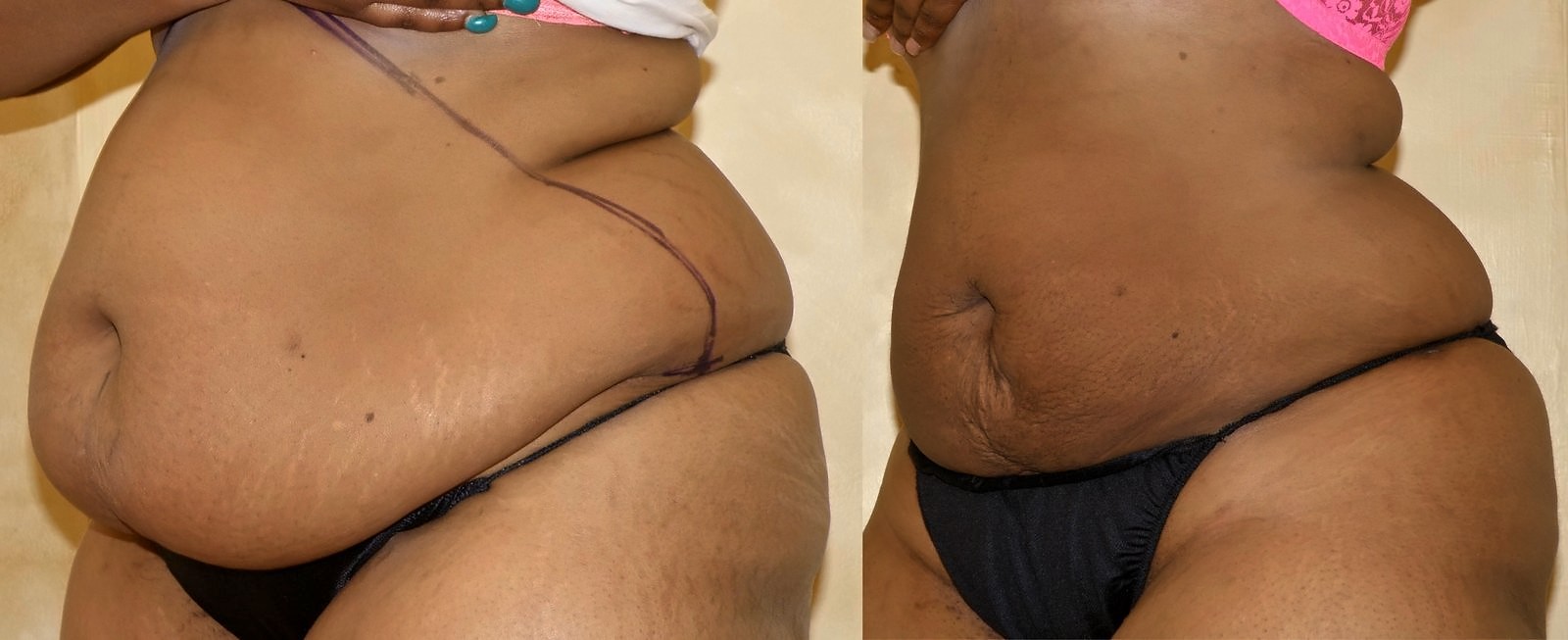 Before/After Lipo 360 before and after, actual patient of Dr. Long