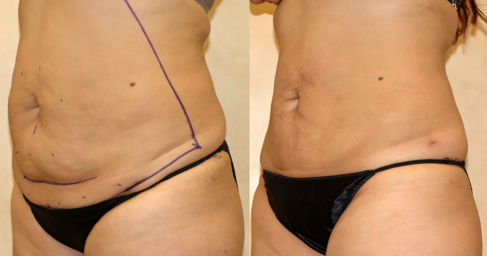 Before/After Lipo 360 before and after, actual patient of Dr. Long