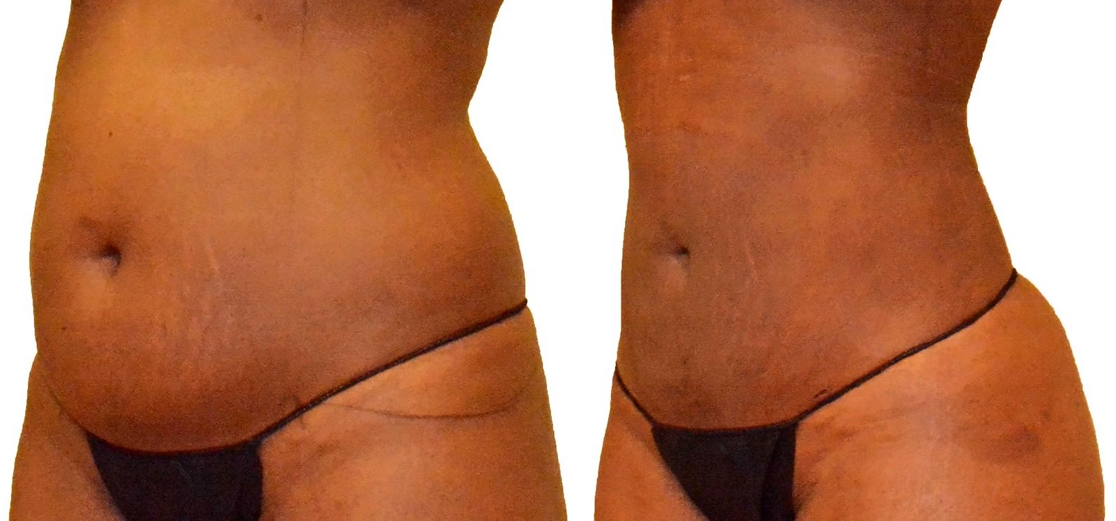 Before/After Lipo 360 before and after, actual patient of Dr. Long